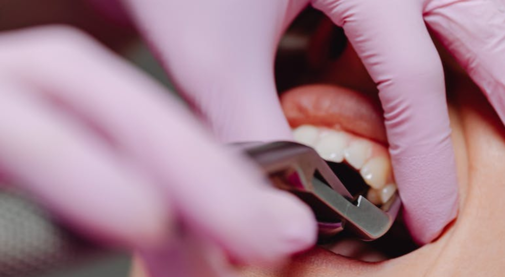 Extraction dents de sagesse avec anesthésie générale ou locale