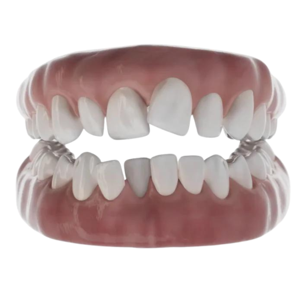 Aligneurs dentaires invisibles : chevauchement dentaire