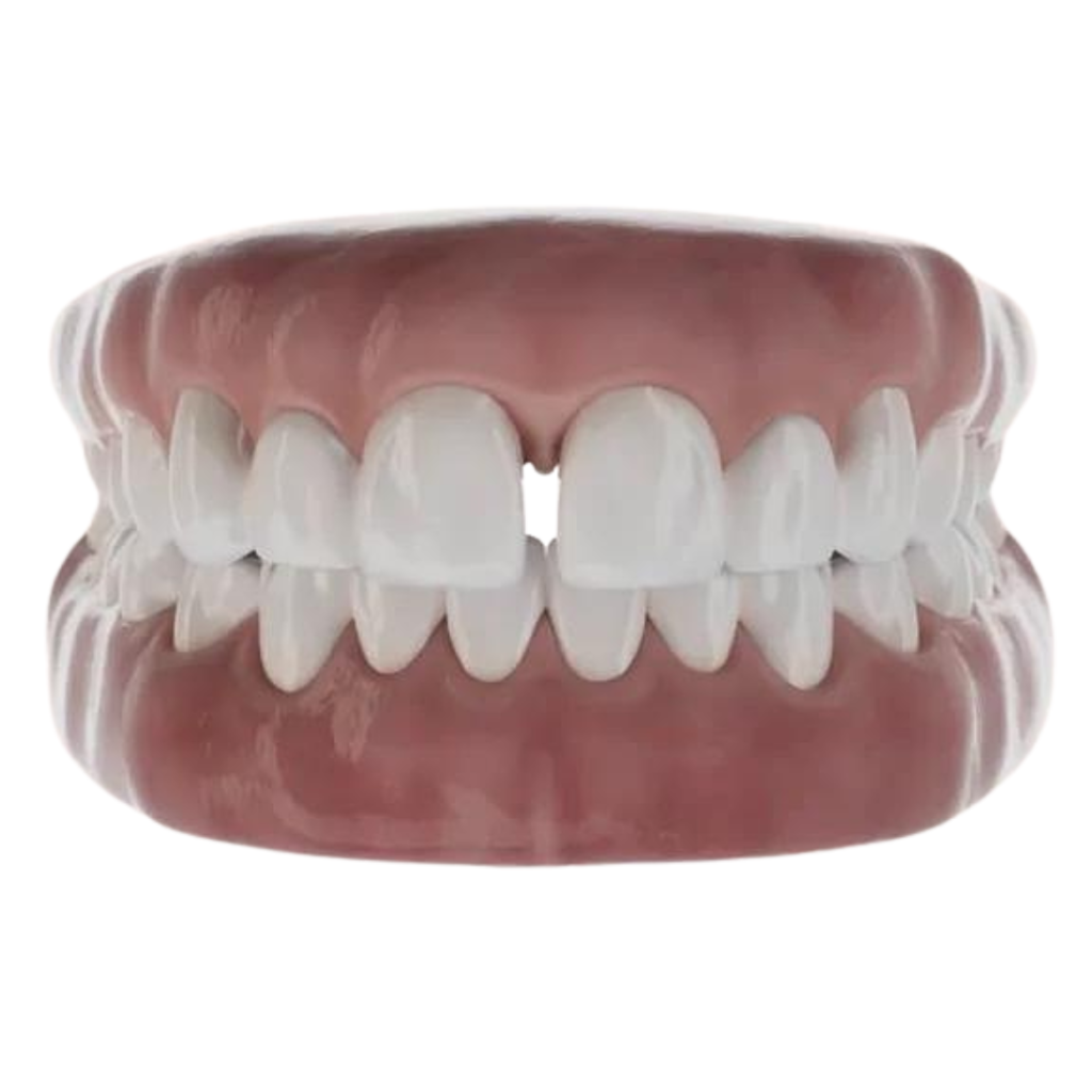 aligneurs dentaires invisibles : espacement dentaire
