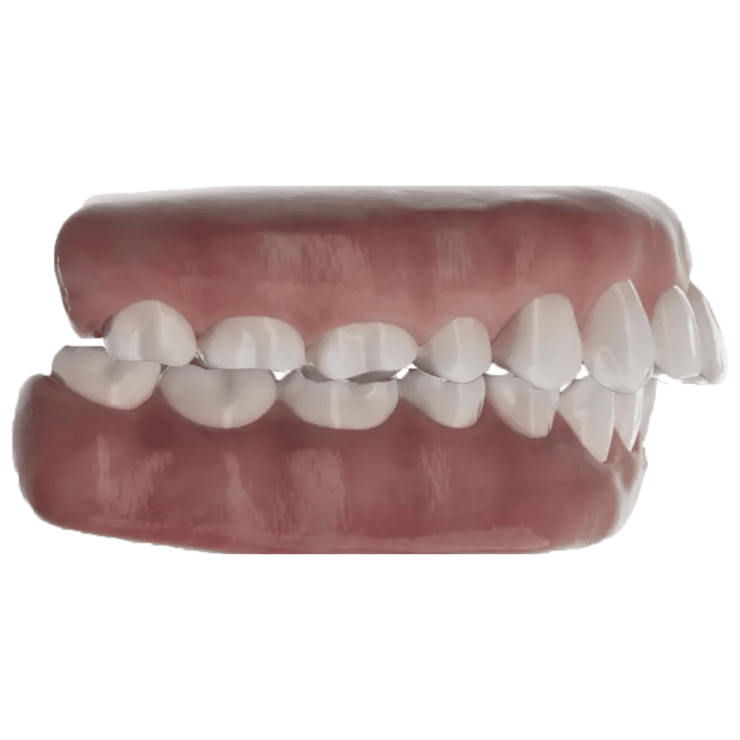 Lot De 100 Outils De Retrait Pour Aligneurs Dentaires (Invisalign) - Extracteur - Neuf