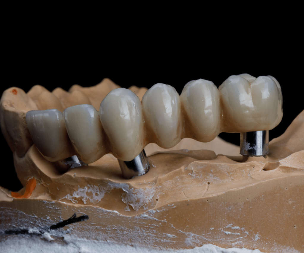 Implantologie bridge dentaire sur implant