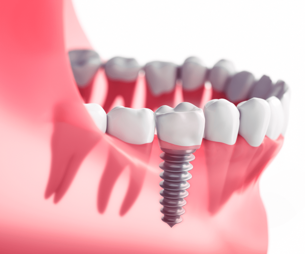 Implantologie tout savoir sur les implants