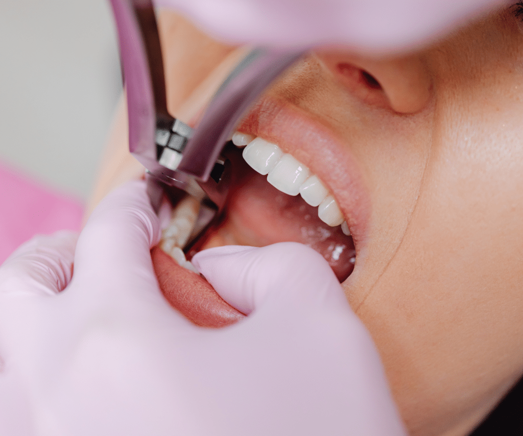 Soins dentaires extraction de dents de sagesse