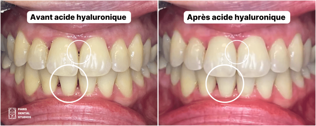 avant après injections à l'acide hyaluronique correction des triangles noirs