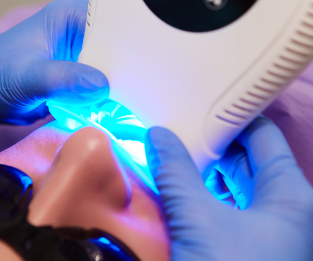 Éclaircissement dentaire au fauteuil réalisé par des dentistes