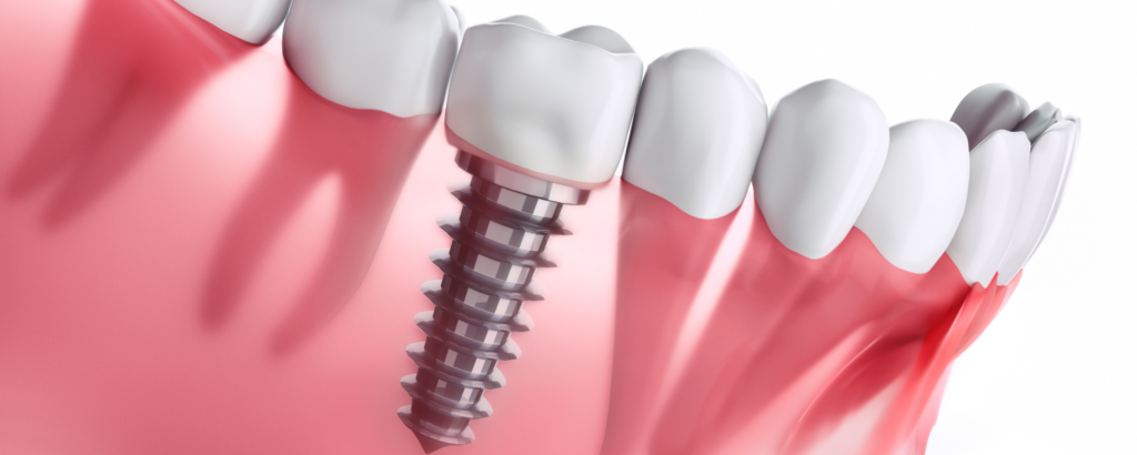 implants dentaires image dentiste