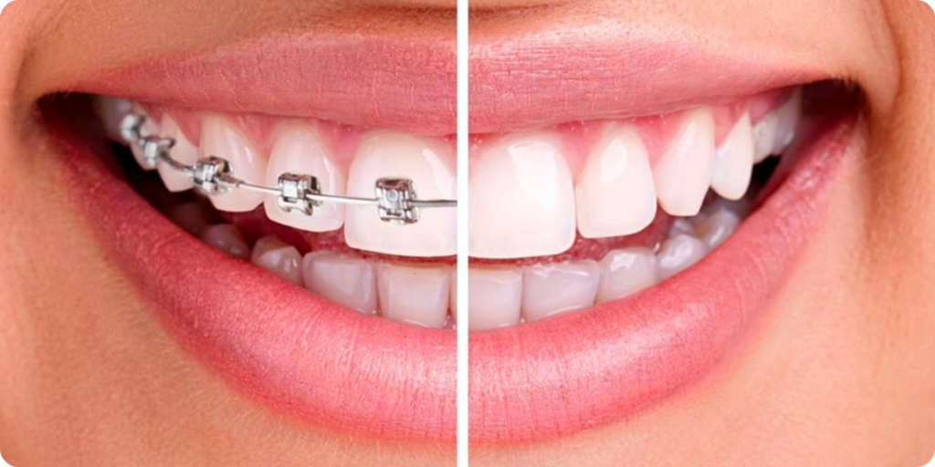 Gouttières invisibles vs bagues, quelle solution d’orthodontie choisir ?
