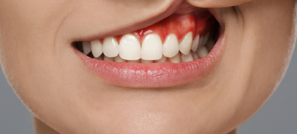 maladie dentiste parodontite