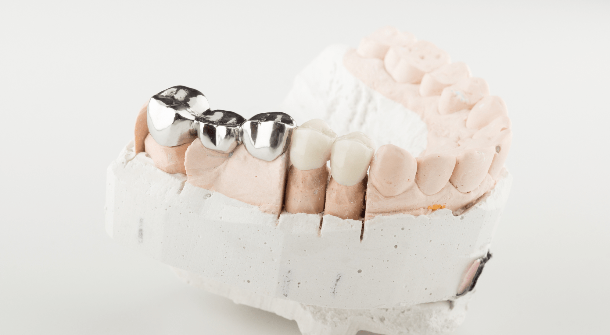 Coût et Remboursement des Prothèses Dentaires - Paris Dental Studios
