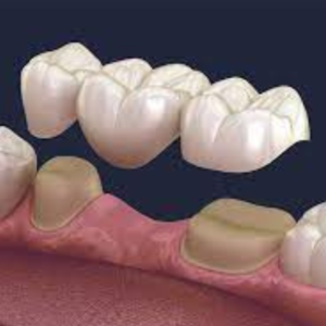 Prothèse dentaire : pose de bridge dentaire par des dentistes formés et spécialisés