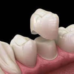 Prothèse dentaire : pose de couronne dentaire par des dentistes formés et spécialisés