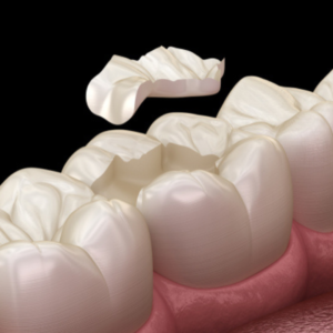 Prothèse dentaire : pose d'inlay dentaire par des dentistes formés et spécialisés