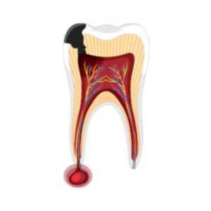 URGENCES DENTAIRES - Consultez un dentiste rapidement : Traitez votre carie dentaire