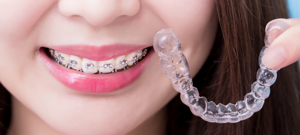 Les alternatives aux appareils orthodontiques