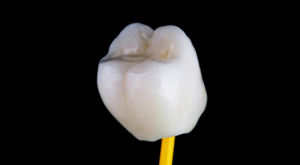 les prothèses dentaires : couronnes dentaires