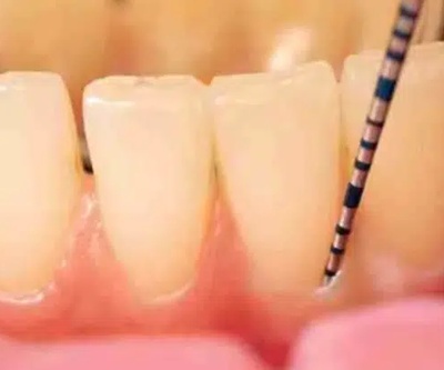 Surfacage-dentaire-curetage-parodontal